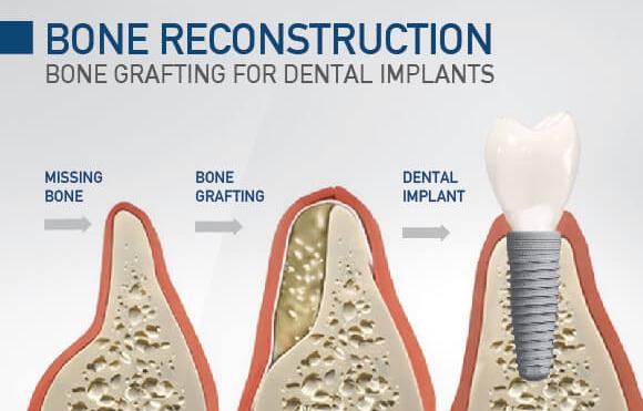 Dental Bone Graft Cost