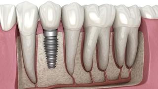 Top 5 European destinations for dental implants abroad 2021