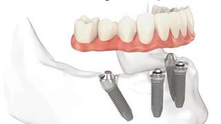 How to Get Affordable Dental Implants in the UK via Dental Travel Agency
