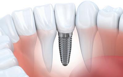 Why are dental implants so expensive in the UK?