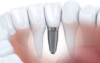 Affordable Teeth Implants in Albania