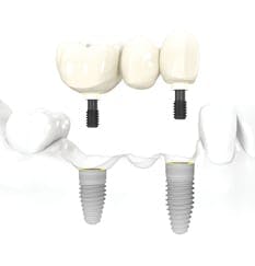 2 Teeth Implant Bridge in Albania