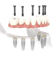 All on 6 Teeth Implants in Albania