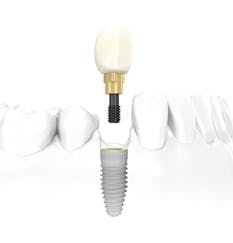 Single Tooth Implant in Albania