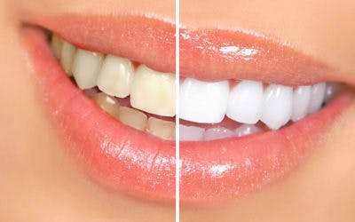 Teeth Whitening Treatment in Albania