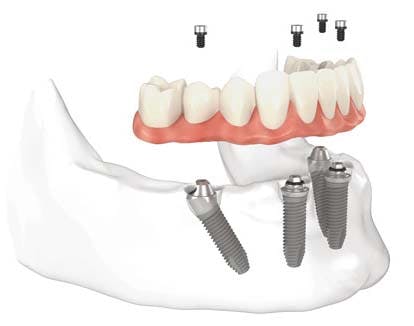 How to Get Affordable Dental Implants in the UK via Dental Travel Agency